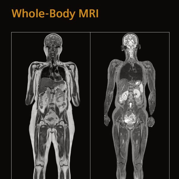 Should you consider a Full Body MRI scan?