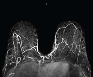 3d-breast-mri