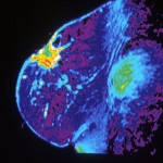 Mri_of_breast