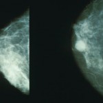 Mammo_breast_cancer