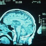 brain-mri-alzheimer