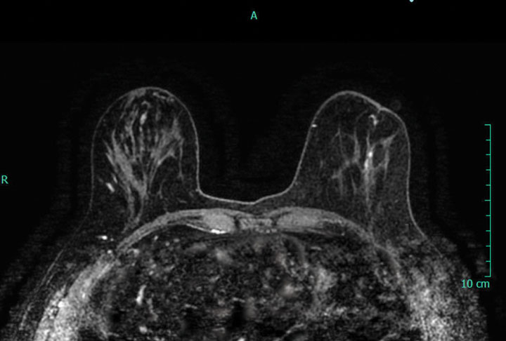 Normal breast MRI - dense breasts, Radiology Case